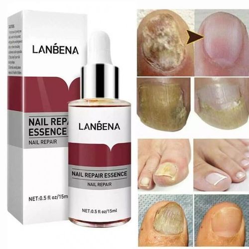 Nail Repair Essence Remove Onychomycosis Serum Fungal Nail Treatment