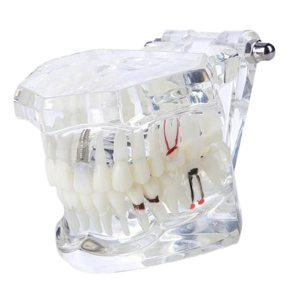 Clear Dental Dissplay Teeth Model Pathological Model Oral Restoration