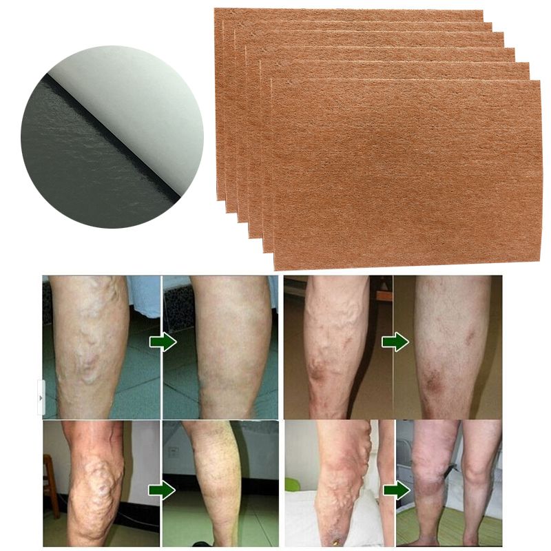 Veins Natural Plaster 60Pcs Treatment Spider Solution Cure Patch Varicose Patches Varicose Herbal Vasculitis Veins