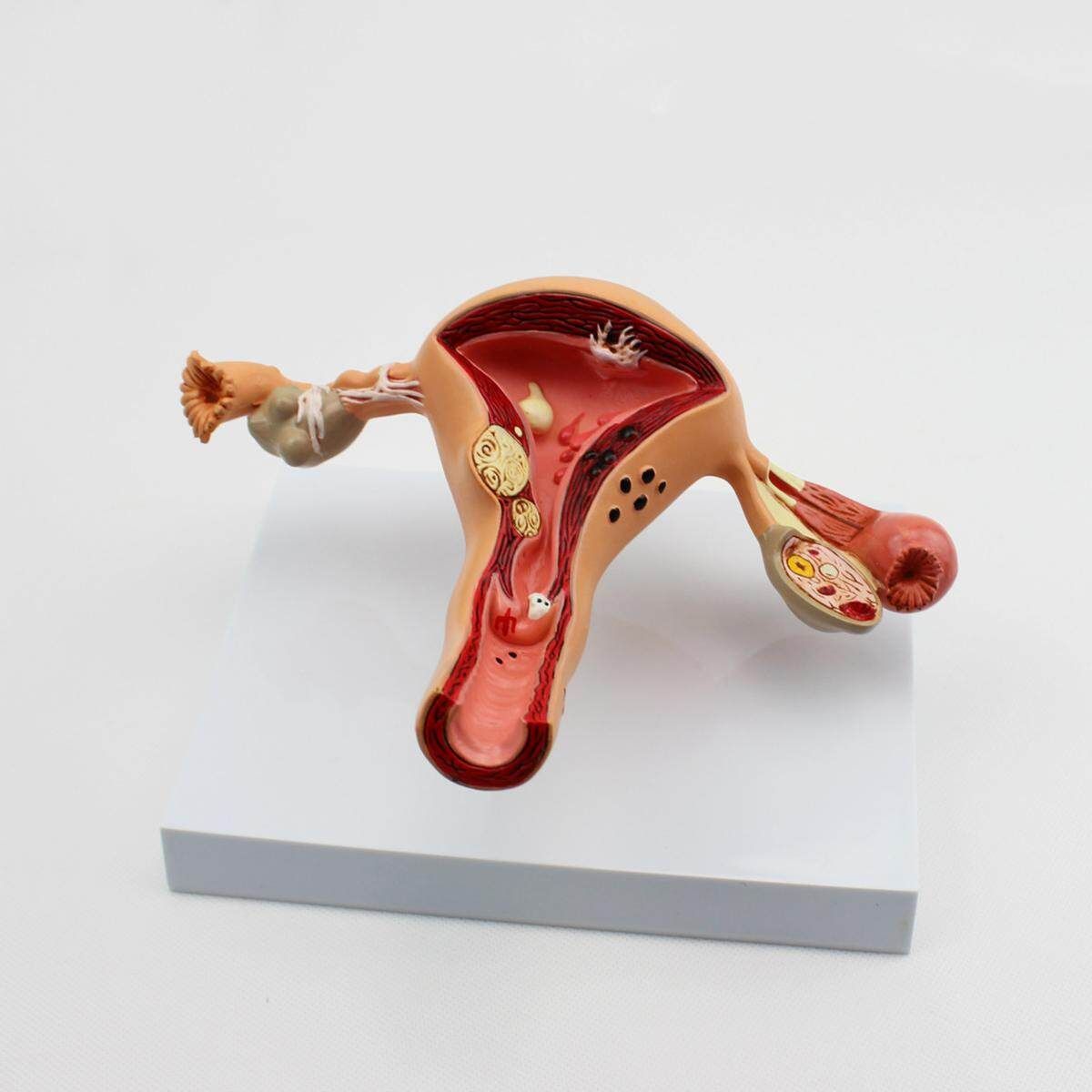 Uterus Ovary Anatomical Model Anatomy Cross-Section Uterine Disease Life Size