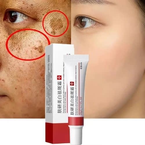 Sunburn Dark Spots & Freckles Removal Cream - 20g