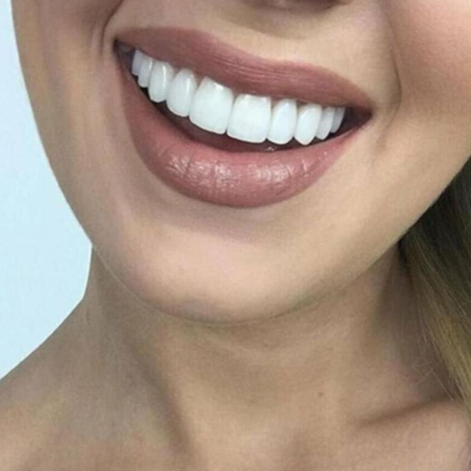 Smiling Snap False Teeth Veneers  Tooth Upper Teeth Braces