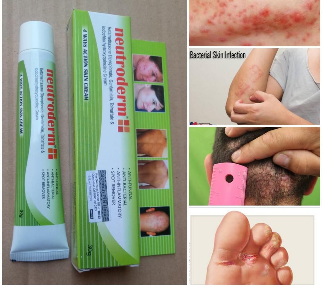 Neutroderm Cream For Spot Removal/General Skin Issues