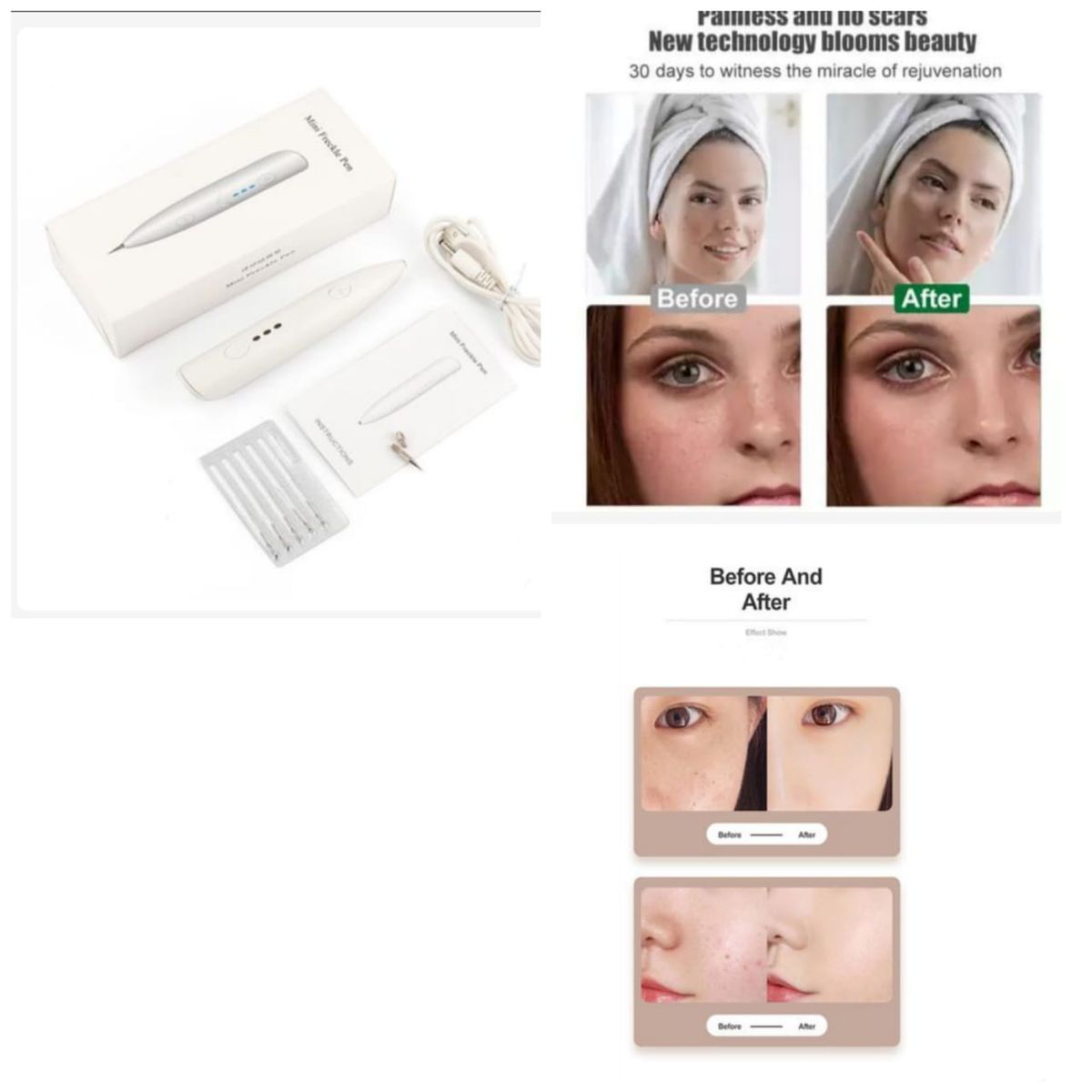 Skin Tag Remover Warts Eliminator Lcd Plasma Pen Papillomas Electric Laser Tattoo Removal Freckle Dark Spot Mole Cauterizer Kit